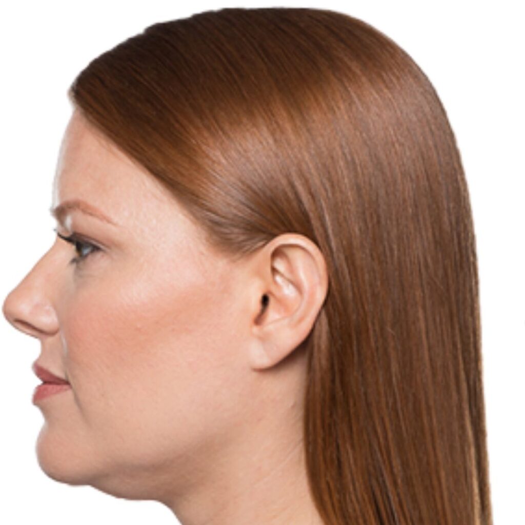 Kybella in Kissimmee