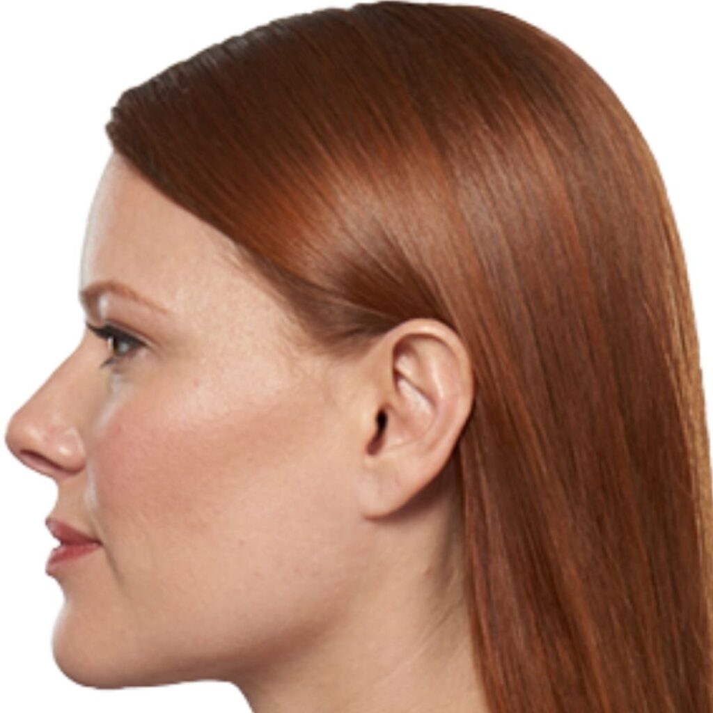 Kybella in Kissimmee